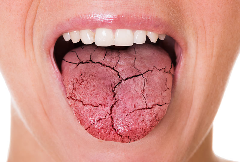 Woman with a cracked tongue indicating dry mouth