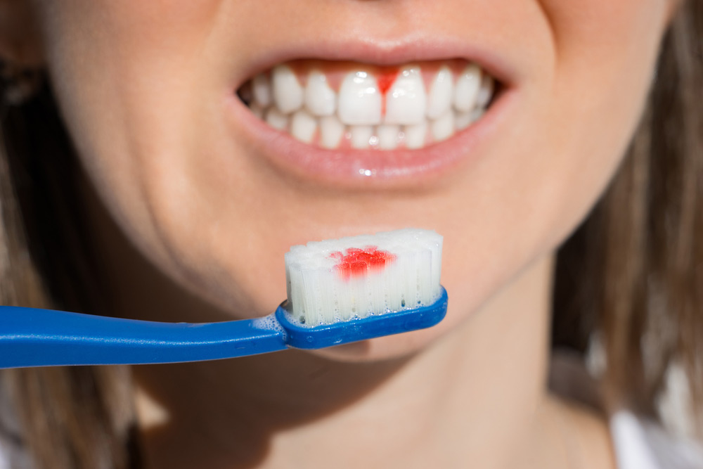 Bleeding gums during tooth brushing